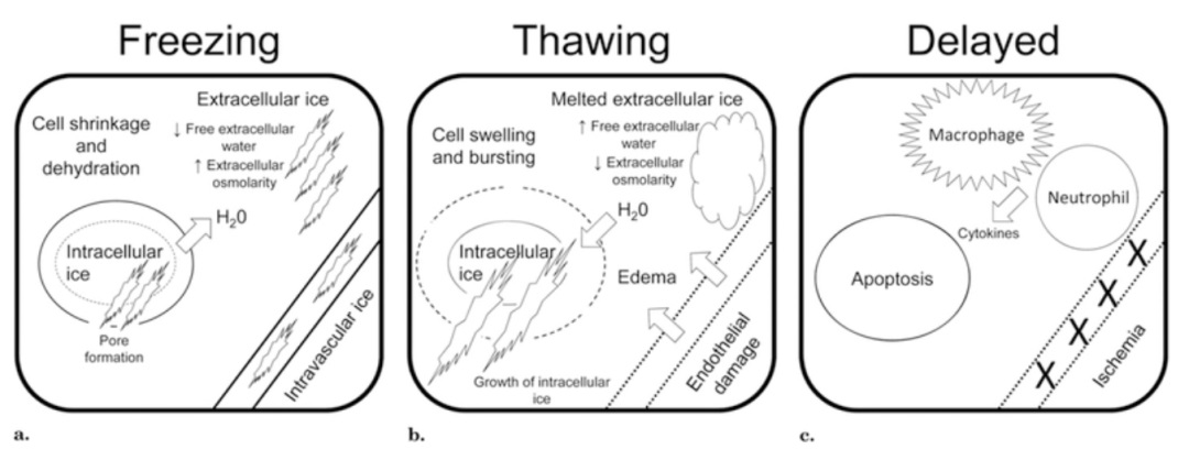 腫瘤治療界的「高冷之花」——腫瘤微創(chuàng  )冷凍消融，國產(chǎn)替代設備空間巨大